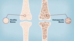 bone-density-and-height-correlation-3