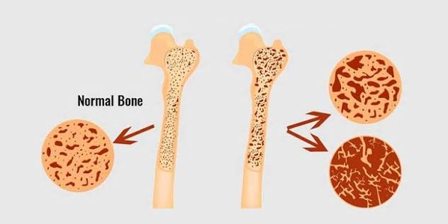 The Power of Collagen in Bone1