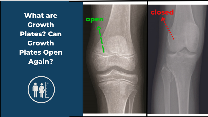 The Science Behind Bone Growth Plates