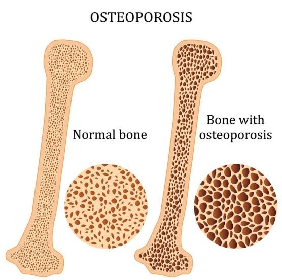 Peak Bone Mass