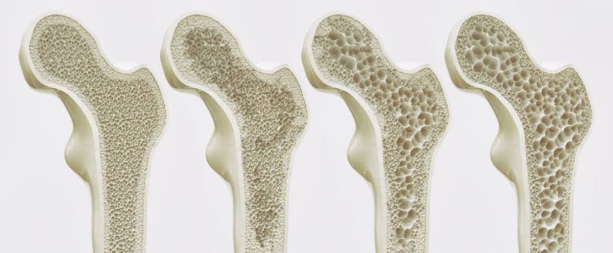 What It Means and How to Support Strong Bones1